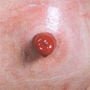Sund peristomale hud