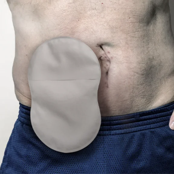 Un primo piano di un uomo che indossa una sacca per stomia a forma di 8 con Leak Defense™.