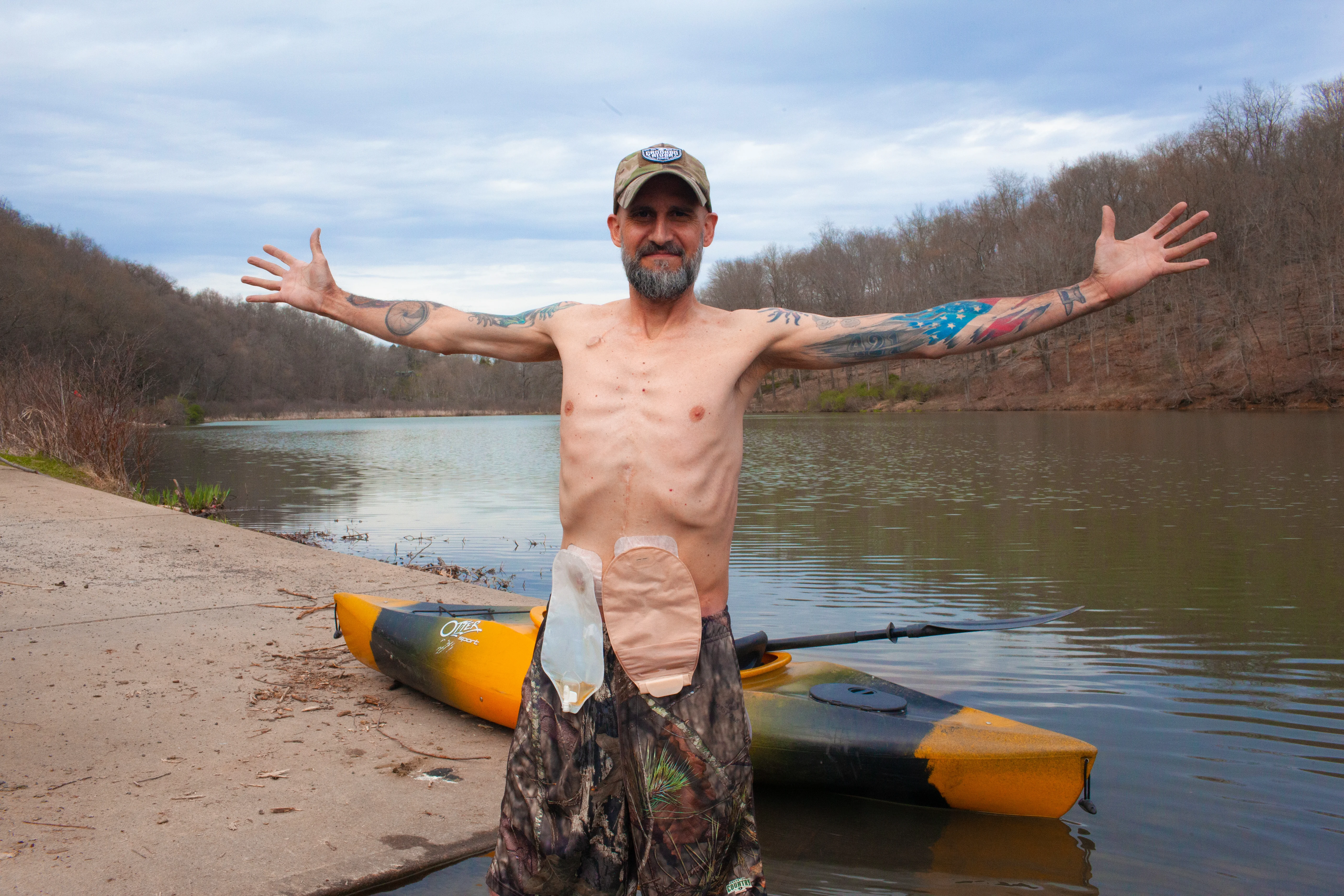 Person with double stoma without leaks.